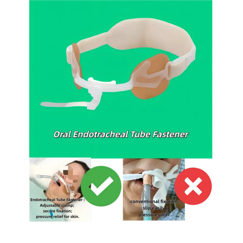 Fixation du tube endotrachéal